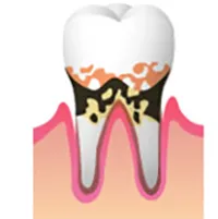歯周炎2